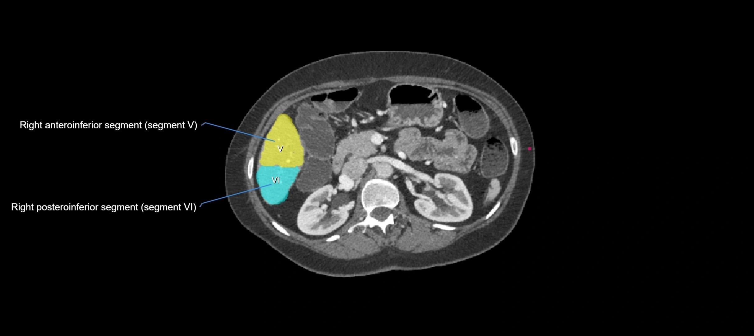 CT liver segments axial cross sectional anatomy labelled image-00025.webp
